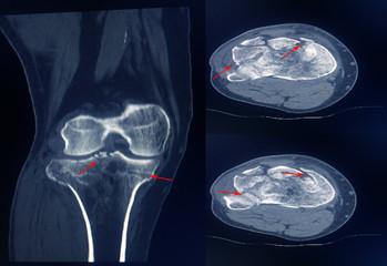 CT Scan knee of the patient periarticular injuries fracture of the proximal tibia frequently...