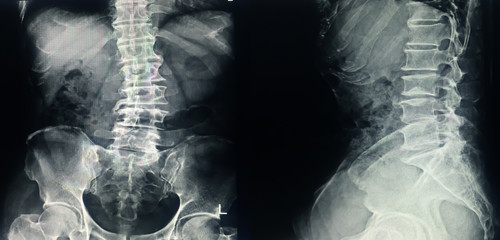 X-ray L-S spine Scoliosis and loss lordosis curve.Narrow L3-4-5 disc space with spur from...