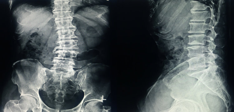 X-ray L-S spine Scoliosis and loss lordosis curve.Narrow L3-4-5 disc space with spur from degenerative change.Normal alignment.No fracture,bony destruction.No opaque calculi.Normal bowel gas pattern.