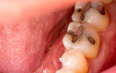 Two back molars with metal fillings on them