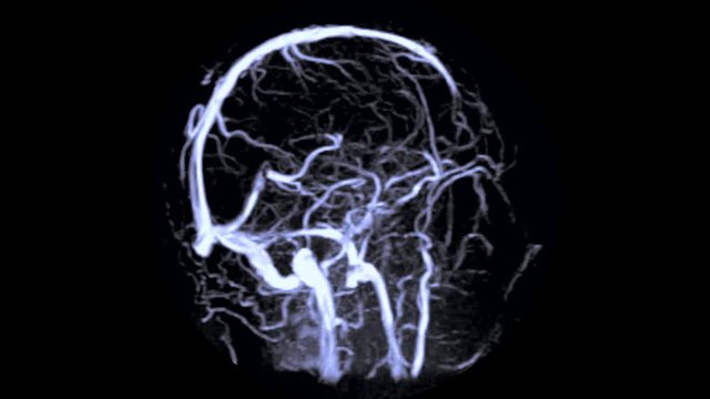  MRV Brain or magnetic resonance venography of The Brain for abnormalities in venous drainage of the brain 