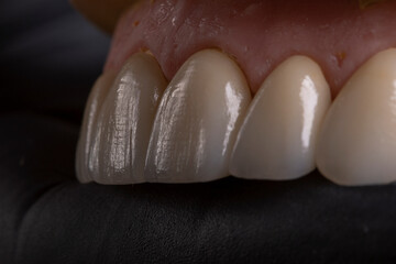  Porcelain Veneers close up. Macro foto