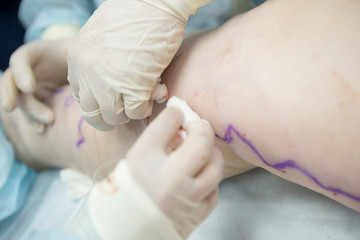 Doctors doing vein surgery procedure