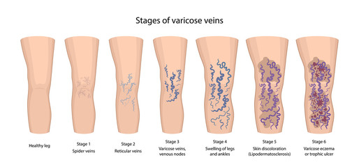 Stages of varicose veins: spider, reticular, nodes, swelling, discoloration skin, eczema, trophic ulcer. Image of healthy and diseased legs. Vector illustration in flat style with main description. - obrazy, fototapety, plakaty
