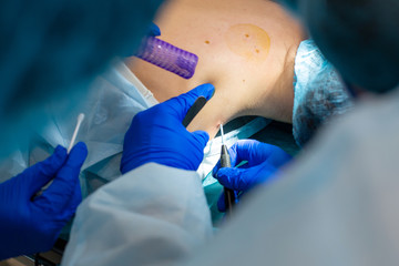 Close-up surgeon burns a mole on the back of the patient. Mole Removal Surgery Procedure