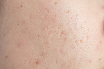 Close up of woman face has problems with skin on her face. Problems with acne and scar on the...