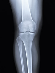 normal radiography of the knee joint in direct projection, medical diagnostics, Traumatology and orthopedics, rheumatology