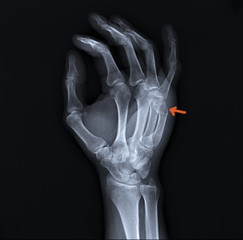 on the x-ray of the hand fracture of the metacarpal bone, traumatology, medical diagnosis