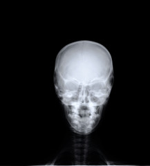 Fototapeta na wymiar normal x-ray of the skull in direct projection, medical diagnostics, traumatology and orthopedics, neurosurgery