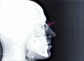 x-ray with a fracture of the back of the nose, traumatology and orthopedics, traumatology, sports...