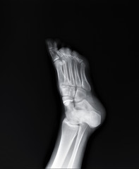 normal radiography of the foot, medical diagnostics, traumatology and orthopedics