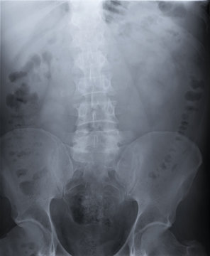 radiography of lumbar and sacral spine, pelvis, coxarthrosis, medical diagnostics