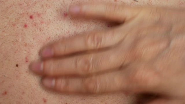 doctor apply small drop amount of medicine ointment on red whitehead pimple and rubs gently. macro close-up 4k UHD video