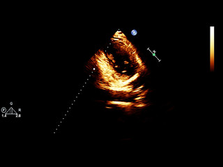 Screen of echocardiography (ultrasound) machine.