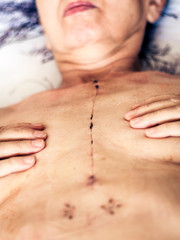 Scar from open heart surgery on the female body, where the sternum was cut in two, and the rib cage sprung. Image taken 30 days (1 month) following surgery.