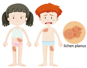 Boy and girl with lichen planus