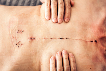 Scar from open heart surgery on the female body, where the sternum was cut in two, and the rib cage sprung. Image taken 30 days (1 month) following surgery. - obrazy, fototapety, plakaty