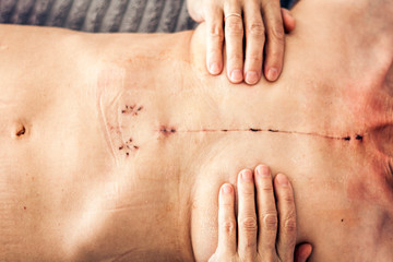 Scar from open heart surgery on the female body, where the sternum was cut in two, and the rib cage sprung. Image taken 30 days (1 month) following surgery.