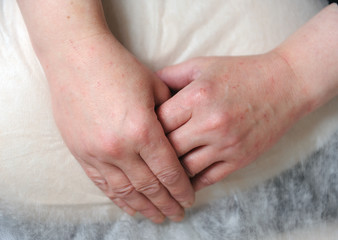 Reddened skin on hands after carbon dioxide therapy (carboxytherapy)