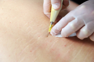 Carbon dioxide therapy (carboxytherapy). Skin rejuvenation.The procedure is performed on the back...