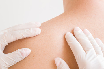 Doctor hands in rubber protection gloves checking skin of young man. Brown freckles on shoulder. Back view. Closeup.