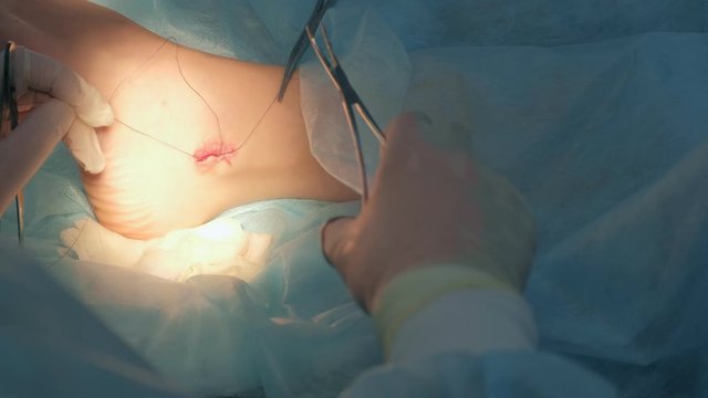 Surgeon man sutures ankle during surgery with neat stitches after removing hygroma using clip, hands closeup. Doctor sewing on wound in operating room in hospital. Seams with self-absorbable threads.