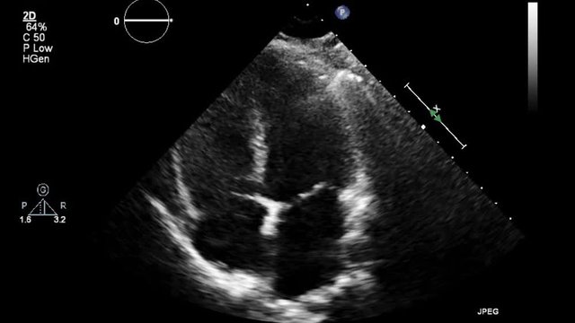 Video transesophageal examination of the heart in hd quality.
