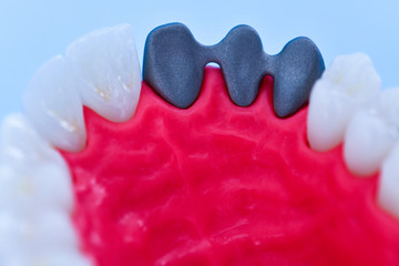 Tooth implant and crown installation process