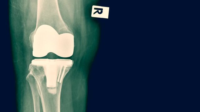 Zoom in X-ray of total knee replacement patient.