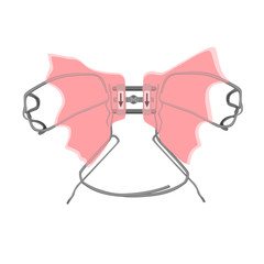 Palatal expander for the maxilla, vector illustration. The removable orthodontic appliance to make the upper jaw wider. This appliance is commonly used to treat children and adults with narrow jaws