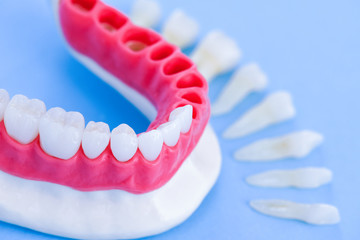 Tooth implant and crown installation process