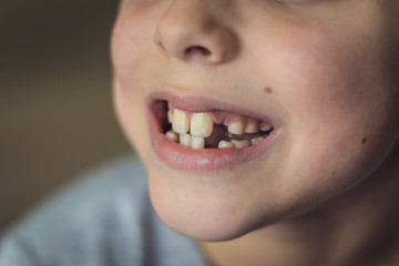 Closeup mounth of 8 years old kid, european boy showing temporary baby milk teeth missing,...