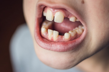 Closeup mounth of 8 years old kid, european boy showing temporary baby milk teeth missing, childhood and dentistry or medical concept, tooth care, natural light shot at daytime