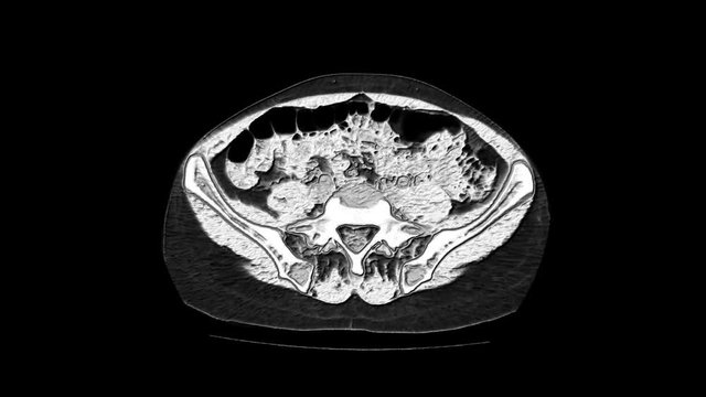 Contrast MRI of the abdominal cavity, gastrointestinal tract, bladder