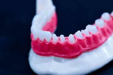 Tooth implant and crown installation process