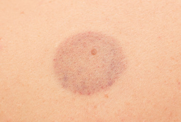 Fototapeta premium Bruise on the skin