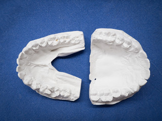 Gypsum model  plaster cast for dental molar in laboratory