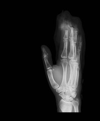 Right hand x-ray image showing the fingertips are cut by a saw, obluqe view