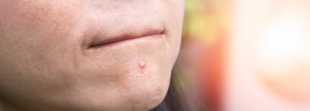 Acne pimple between mouth and chin in Asian woman skin face close up with hands to pop.