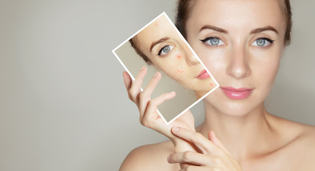 woman face portrait with clear and pimpled skin / skin treatment products concept for design
