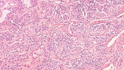 Photomicrograph of a carotid body tumor,  a paraganglioma at the carotid bifurcation.  Malignant behavior of these tumors is unpredictable.  
