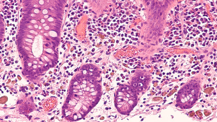 Photomicrograph of an endoscopic colon biopsy (colonoscopy) showing melanosis coli, an accumulation of brown pigment (lipofuscin) within macrophages of the colonic mucosa, related to use of laxatives.