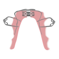 Palatal expander for the lower jaw to treat children with narrow jaws and vertical face growth. Flat vector illustration isolated on white.