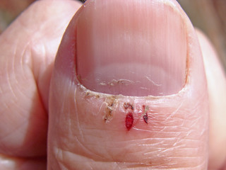 Cracked hangnails 2