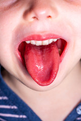 Tongue of a child with scarlet fever - strawberry tongue