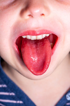 Tongue Of A Child With Scarlet Fever - Strawberry Tongue