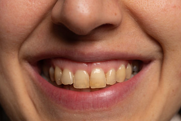 Person with yellow teeth close up