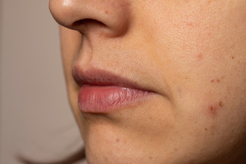 Young woman with rash on cheek close up