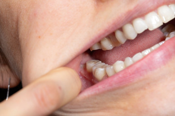 Wisdom tooth dentition close up