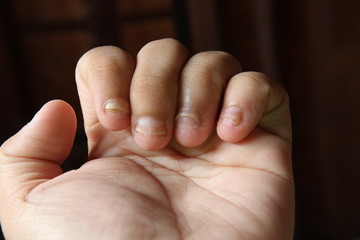 The finger nails have rough skin. Psoriasis